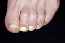 울퉁불퉁 노랗게 변하는 손발톱…‘조갑백선’ 아시나요