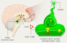 방사선으로 파킨슨병 신경염증 감소 효과··· 새로운 치료법 나올까