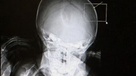 어린이집서 9개월 아기 두개골 골절…은폐 의혹