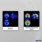[한컷뉴스] 치매 미리 알면 늦출 수 있다