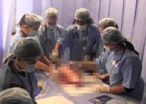 ‘세계최초’ 男성기 축소술… 크기가?