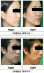 (주)로츠, 이온·초음파·레이저 기능 갖춘 휴대용 피부관리기 생산 및 보급