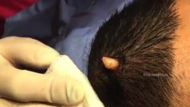 [SNS 세상] 사람 머리에서 흰 뿔이? 알고보니 피지 낭종