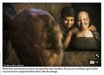 [뉴스pick] 염산 테러 당한 여성에게 반해 프러포즈한 남성 뭉클