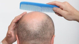 탈모 치료제 피나스테리드, 우울증·자살 위험 높여