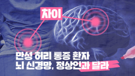 만성 허리 통증 환자 뇌 신경망, 정상인과 달라