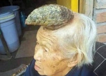 [투데이SNS] 사람 머리에 13cm 뿔 자라