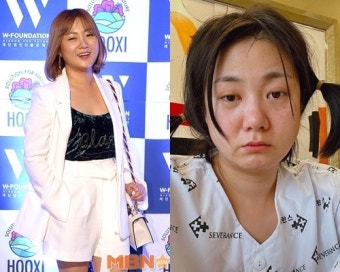 박나래, 성대 수술 후 홀쭉해진 얼굴로 “잠깐 고치는 중...지금은 퇴원”(전문)