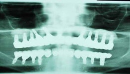 임플란트 치료, 이젠 낮잠 잔 느낌으로