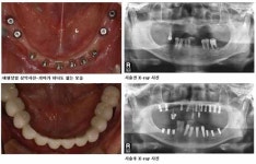 잘 먹고 잘 사는 즐거움, 임플란트로 누리세요
