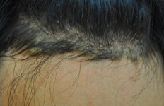 잦은 술자리, 지루성두피염 탈모 위험