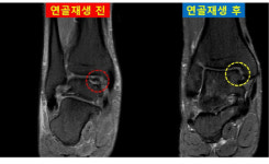 발목연골손상 이제 당일수술, 퇴원시대다