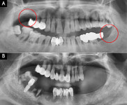[치과전문의 칼럼] 임플란트가 자연치아 살리기 방법이 된다?