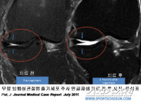 심장 약한 고령층, 무릎관절염 非수술적 재생 고려