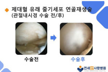 백세시대 도래, 무릎 관절염 치료 패러다임 바꾸는 줄기세포 연골재생술
