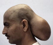 얼핏 보면 머리가 두 개...15년간 뒤통수에 혹 달고 다닌 남성