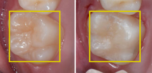 영유아~청소년, 건보 적용 치과 검진·치료 항목은?
