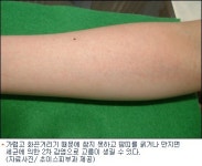 찜통더위 속 땀띠, 수험생, 임신부, 아이들은 괴로워