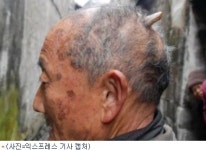 뒤통수에 뿔 난 중국 80대男 출현 계속 자라