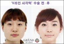 ‘V라인 사각턱수술’ 잘하는 곳, 뭐가 다르지?