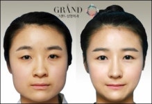 V라인 만들기, 사각턱수술 이외의 방법은?