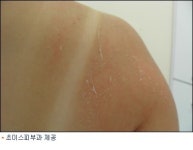 태닝 이래도 하시겠습니까?