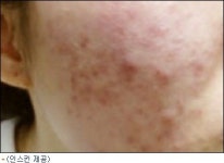 가을에도 피지와 여드름으로 고민이라면