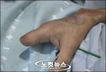 화재로 사지 절단한 어느 가장의 기구한 사연