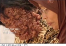 온 몸에 혹 달린 버블맨, 결국 아이들 위해…