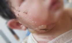 “2도 화상 아기…아무 곳에서도 안 받아주네요”[이슈픽]