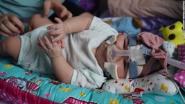 [월드피플+] 세계서 가장 작은 212g 조산아, 1년 만에 기적 퇴원