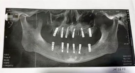 한번에 치아 23개 뽑고 임플란트 12개 이식한 男 심장마비 사망…中 시끌