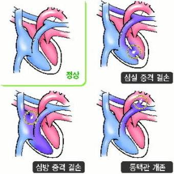 [베스트 닥터 in 부산] 선천성 심장질환