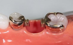 치아 수술 아픔없이 건너는 휴먼브릿지