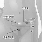 자궁내막암, 발생률 낮다고 가볍게 여겼다가는…