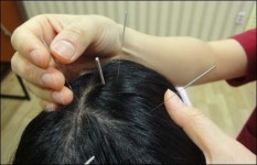 [대구] 가을철 고민 ‘탈모’ 치료와 관리, 한의원 한방치료는 어떻게