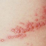 대상포진 예방법 폭염으로 수두바이러스 스물 스물…비타민, 수면 꼭 필요!