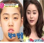 렛미인 허예은, “양악, 코, 눈 앞트임, 이마…大성형 후에 고통이...”