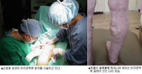 [의료특집] 부강외과의원-하지정맥류