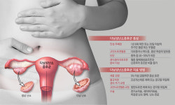 다낭성난소증후군