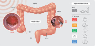[건강+] 초기엔 무증상 ‘대장암’