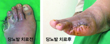 [더본연합정형외과] 당뇨 족부 궤양 최신 고압산소치료