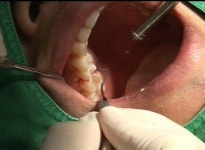 [건강] 임플란트보다 싼 자연치 살리기 치료법