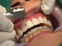 [건강] 치아 미백으로 자신있는 웃음 찾으세요