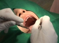 [건강] 누런 치아에 레몬 문지르면 하얗게 변신?