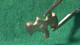 금니가 금이 아니다?…어이없는 치과