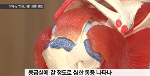 [취재파일] 어깨 속 석회덩어리…방치하다간 응급실행