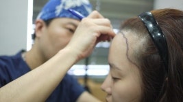 [리빙] 헤어라인 교정, ‘통증ㆍ붓기’ 없이 빠르게 회복하는 방법은?