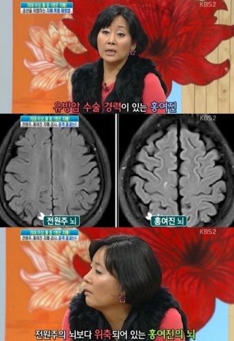 홍여진, 과거 유방암 수술로 인한 치매 발병 우려