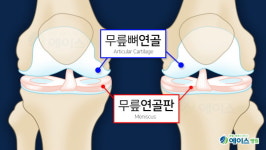 무릎 관절염, 연골판과 뼈연골은 달라 
